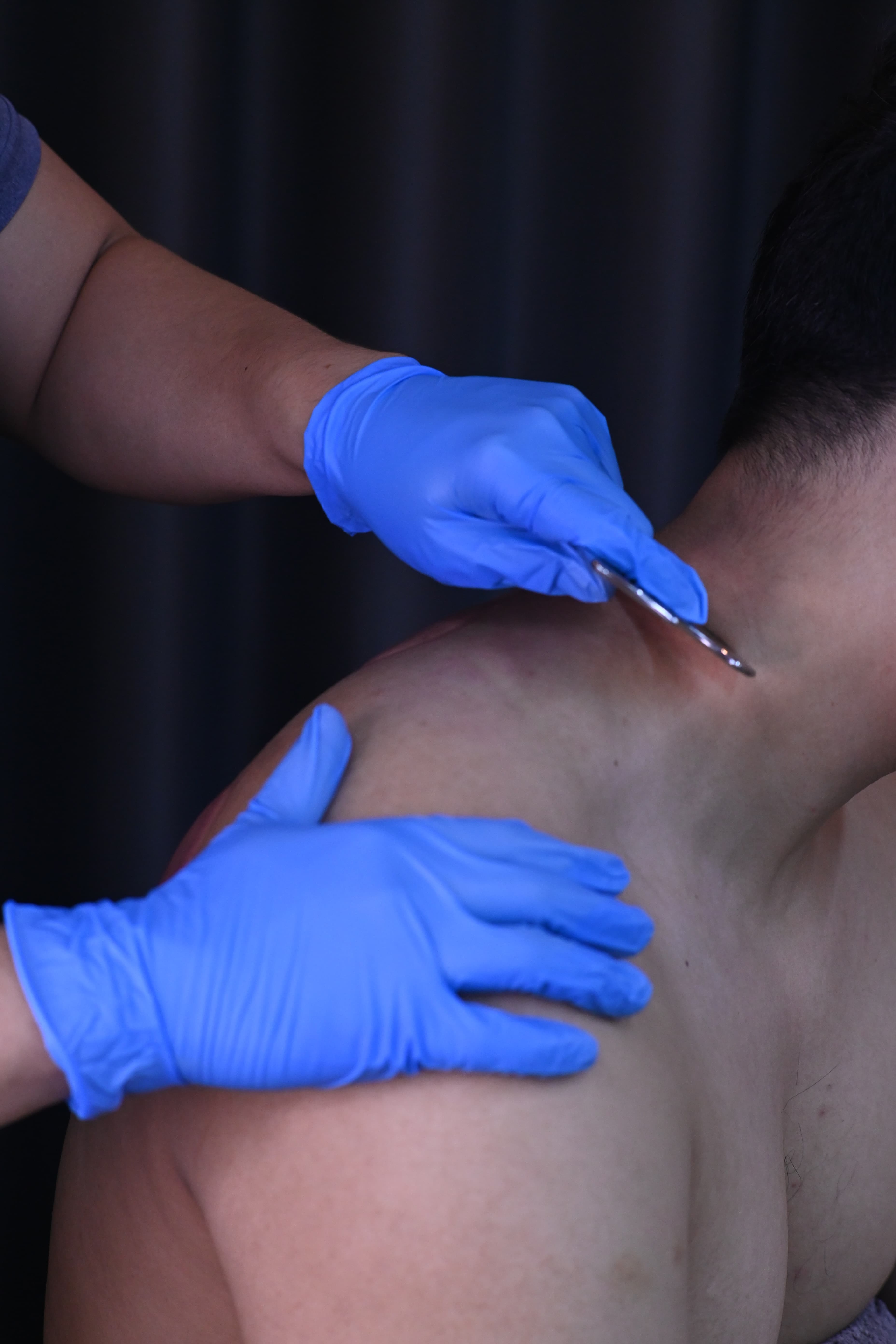 A dry needling treatment in progress